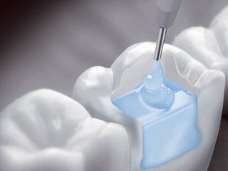 Композит для реставрации боковой группы зубов SDR, Dentsply шпр. 1 гр.